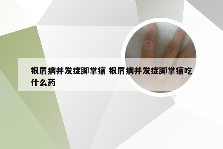 银屑病并发症脚掌痛 银屑病并发症脚掌痛吃什么药