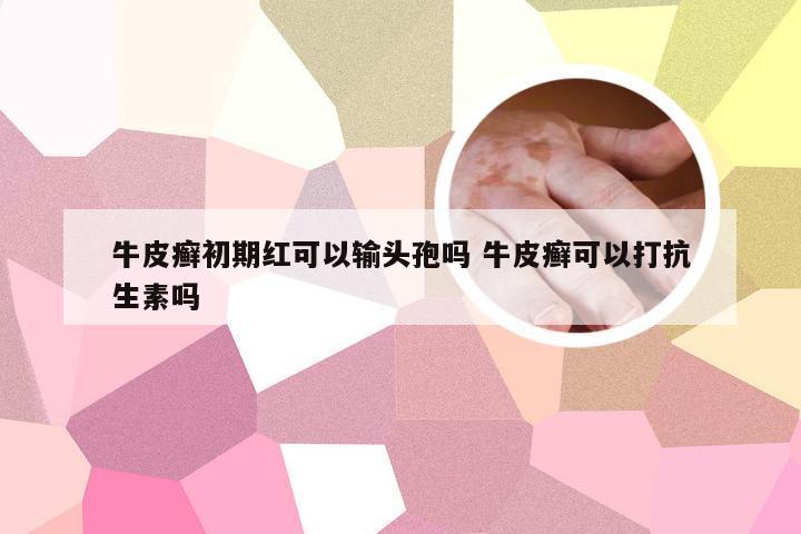 牛皮癣初期红可以输头孢吗 牛皮癣可以打抗生素吗