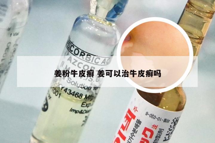 姜粉牛皮癣 姜可以治牛皮癣吗