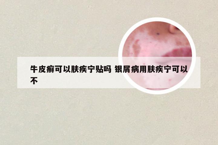 牛皮癣可以肤疾宁贴吗 银屑病用肤疾宁可以不