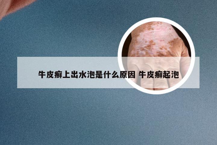 牛皮癣上出水泡是什么原因 牛皮癣起泡