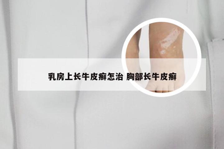 乳房上长牛皮癣怎治 胸部长牛皮癣