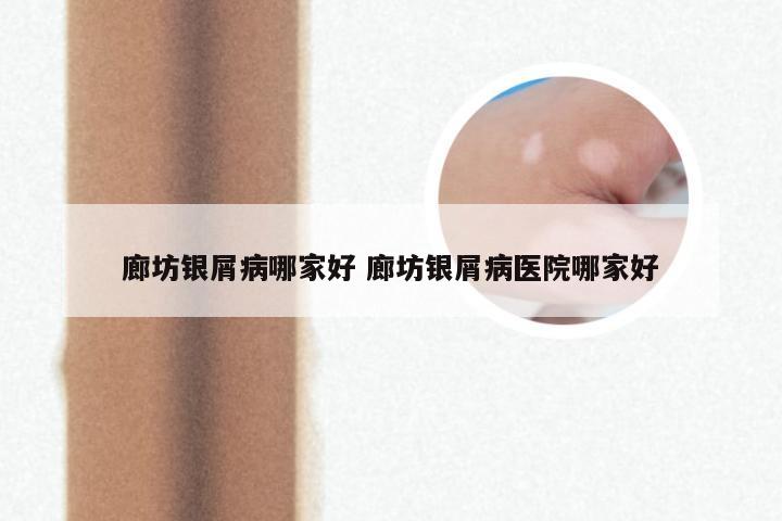 廊坊银屑病哪家好 廊坊银屑病医院哪家好