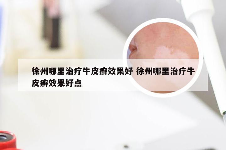 徐州哪里治疗牛皮癣效果好 徐州哪里治疗牛皮癣效果好点