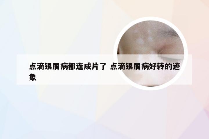 点滴银屑病都连成片了 点滴银屑病好转的迹象