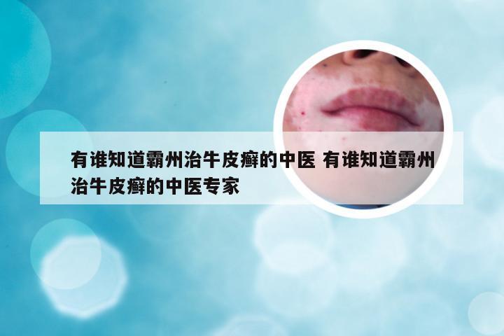 有谁知道霸州治牛皮癣的中医 有谁知道霸州治牛皮癣的中医专家