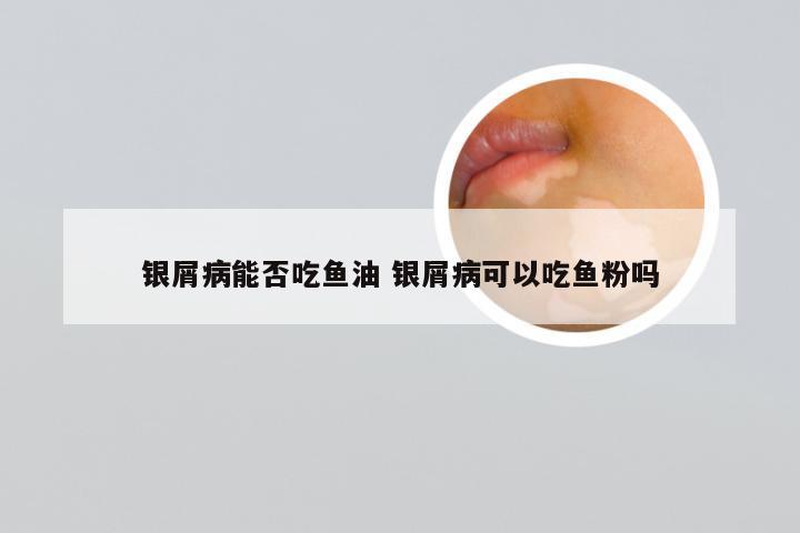 银屑病能否吃鱼油 银屑病可以吃鱼粉吗