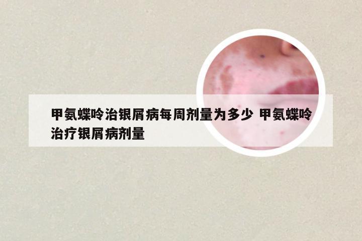 甲氨蝶呤治银屑病每周剂量为多少 甲氨蝶呤治疗银屑病剂量