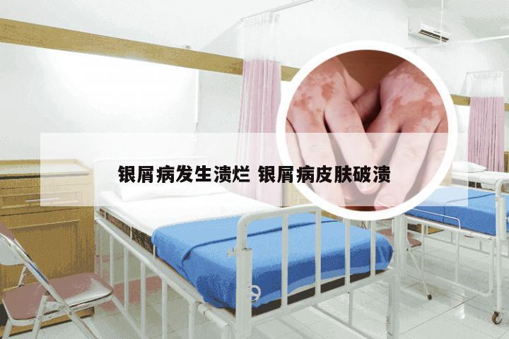 银屑病发生溃烂 银屑病皮肤破溃