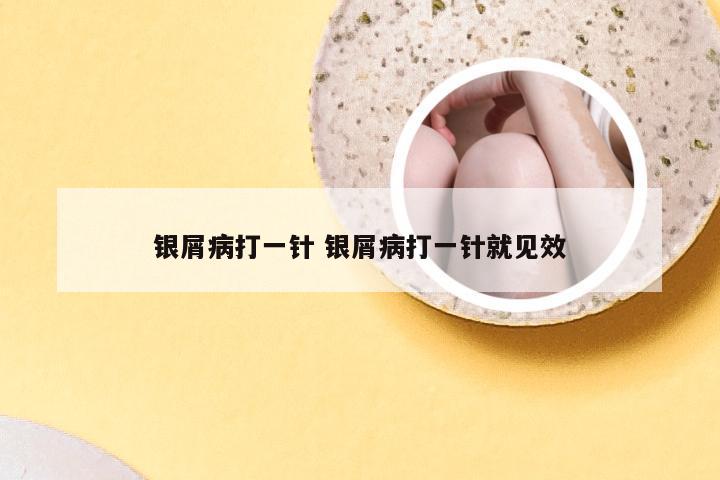 银屑病打一针 银屑病打一针就见效