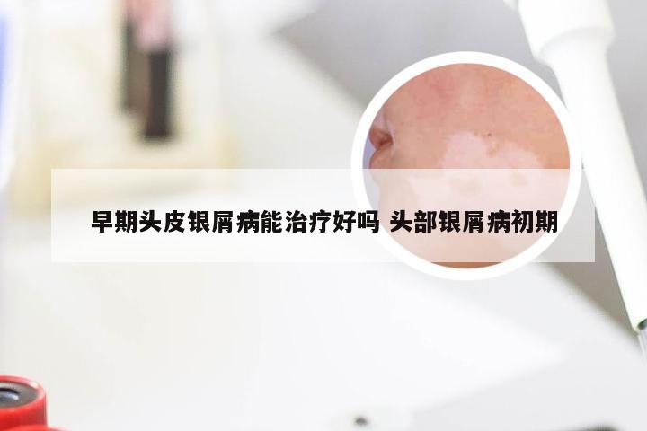 早期头皮银屑病能治疗好吗 头部银屑病初期