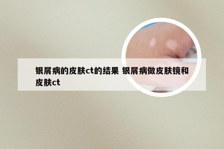 银屑病的皮肤ct的结果 银屑病做皮肤镜和皮肤ct