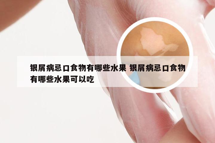 银屑病忌口食物有哪些水果 银屑病忌口食物有哪些水果可以吃