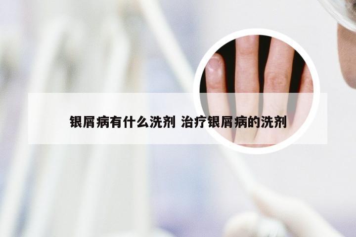 银屑病有什么洗剂 治疗银屑病的洗剂