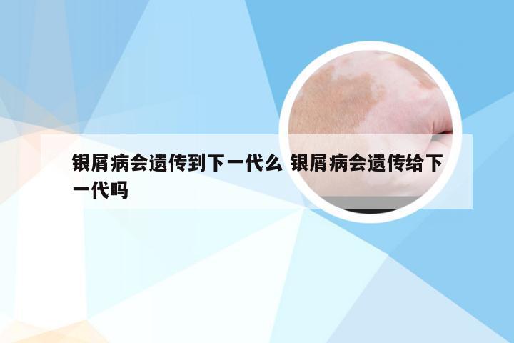 银屑病会遗传到下一代么 银屑病会遗传给下一代吗
