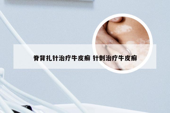 脊背扎针治疗牛皮癣 针刺治疗牛皮癣