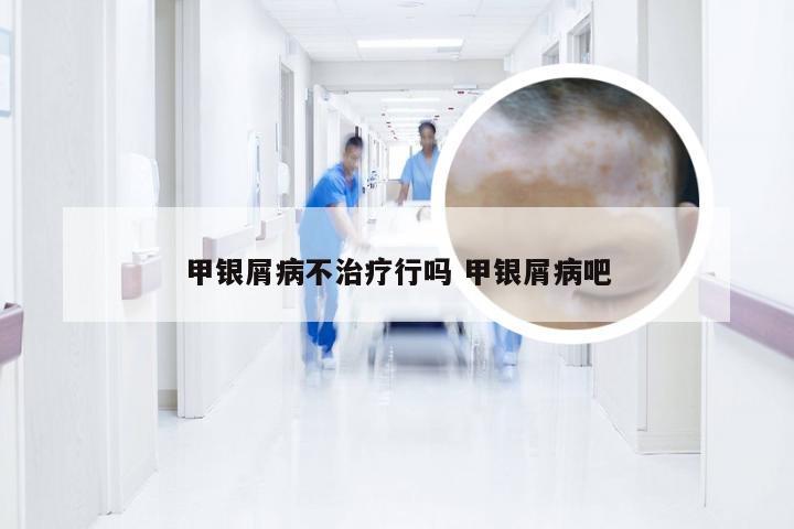 甲银屑病不治疗行吗 甲银屑病吧