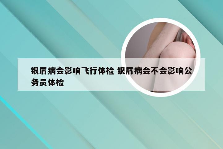 银屑病会影响飞行体检 银屑病会不会影响公务员体检
