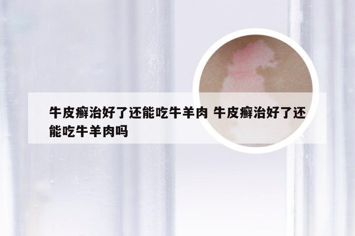 牛皮癣治好了还能吃牛羊肉 牛皮癣治好了还能吃牛羊肉吗