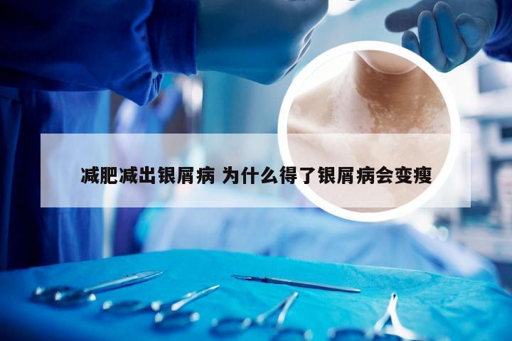减肥减出银屑病 为什么得了银屑病会变瘦