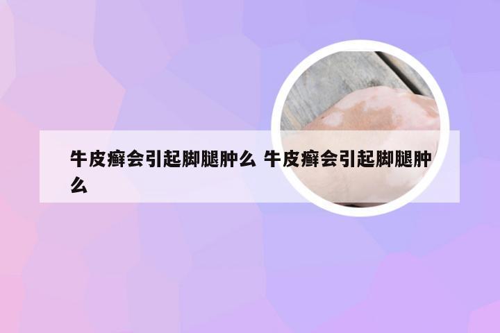 牛皮癣会引起脚腿肿么 牛皮癣会引起脚腿肿么