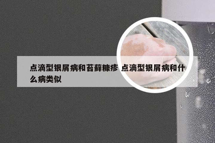 点滴型银屑病和苔藓糠疹 点滴型银屑病和什么病类似