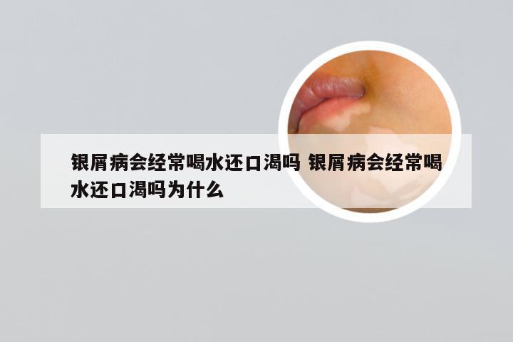 银屑病会经常喝水还口渴吗 银屑病会经常喝水还口渴吗为什么