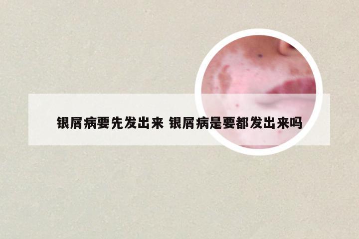 银屑病要先发出来 银屑病是要都发出来吗