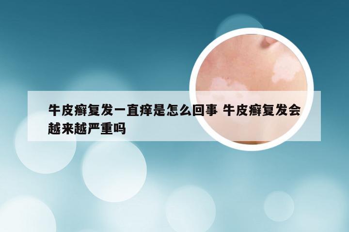 牛皮癣复发一直痒是怎么回事 牛皮癣复发会越来越严重吗