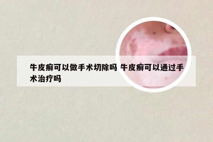 牛皮癣可以做手术切除吗 牛皮癣可以通过手术治疗吗