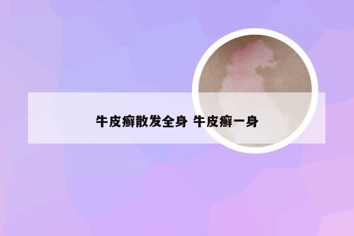 牛皮癣散发全身 牛皮癣一身