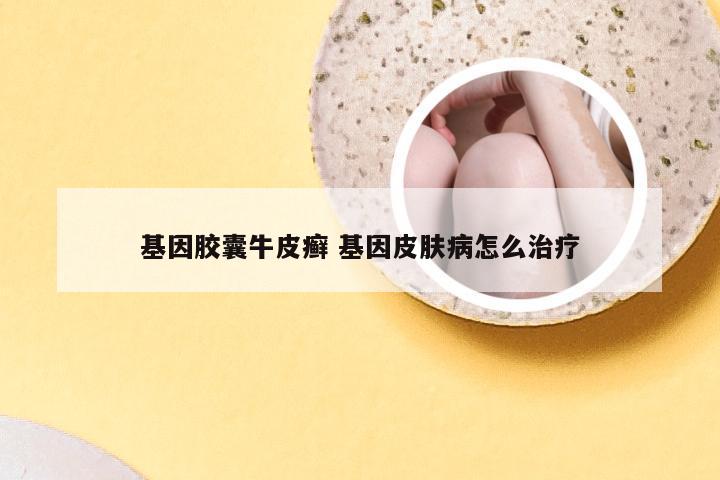 基因胶囊牛皮癣 基因皮肤病怎么治疗
