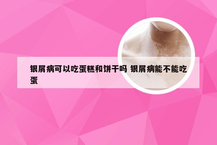 银屑病可以吃蛋糕和饼干吗 银屑病能不能吃蛋