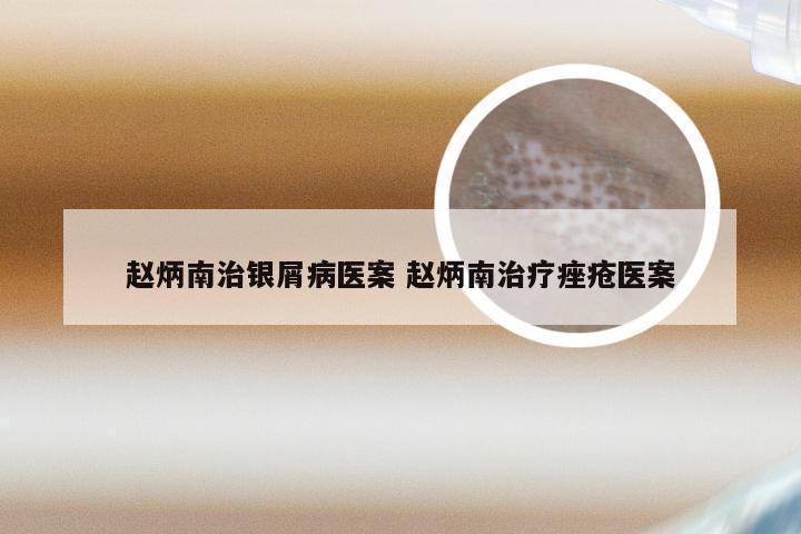 赵炳南治银屑病医案 赵炳南治疗痤疮医案