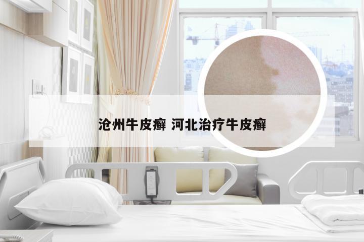 沧州牛皮癣 河北治疗牛皮癣
