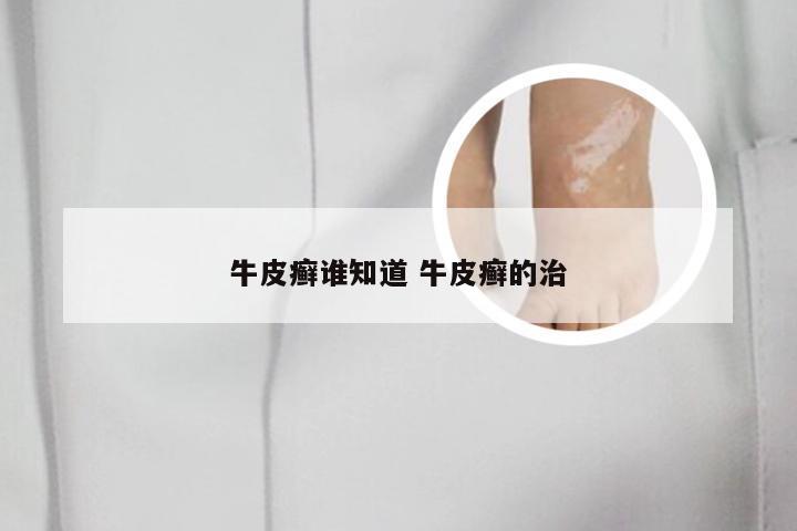 牛皮癣谁知道 牛皮癣的治