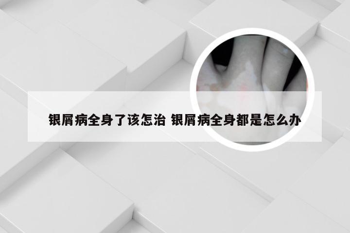 银屑病全身了该怎治 银屑病全身都是怎么办