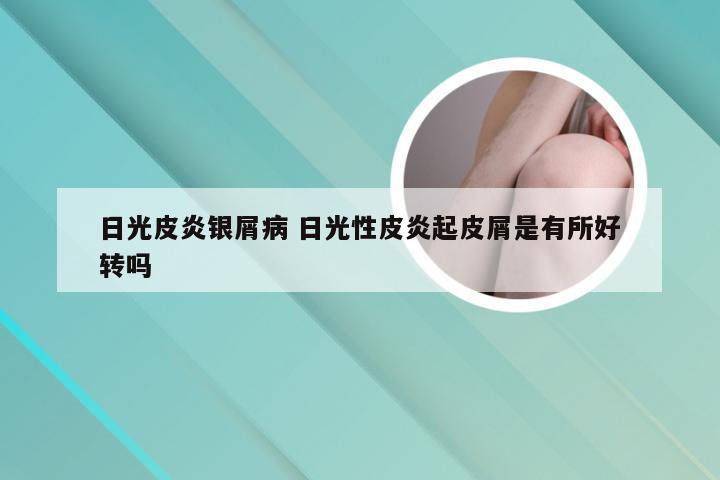 日光皮炎银屑病 日光性皮炎起皮屑是有所好转吗