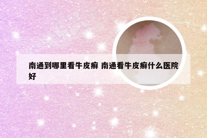 南通到哪里看牛皮癣 南通看牛皮癣什么医院好