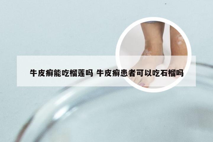 牛皮癣能吃榴莲吗 牛皮癣患者可以吃石榴吗