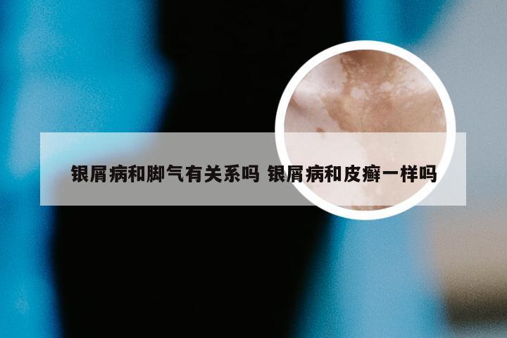 银屑病和脚气有关系吗 银屑病和皮癣一样吗