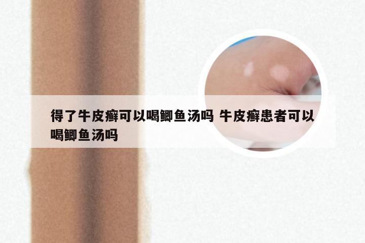得了牛皮癣可以喝鲫鱼汤吗 牛皮癣患者可以喝鲫鱼汤吗