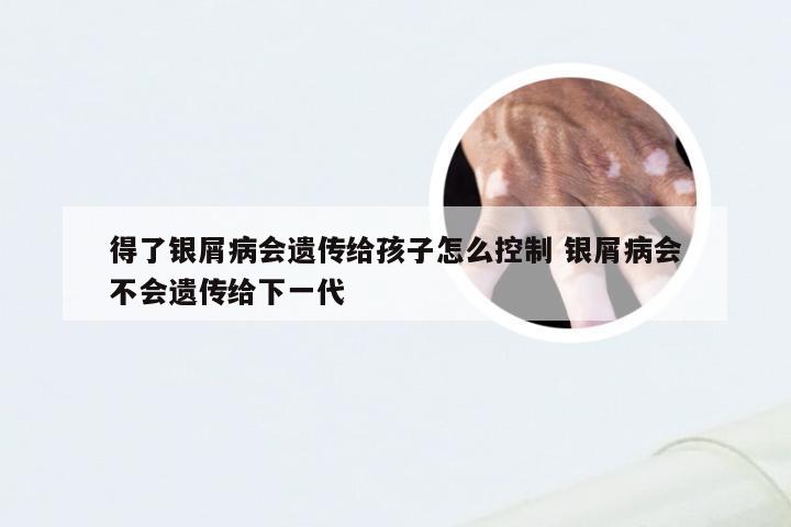 得了银屑病会遗传给孩子怎么控制 银屑病会不会遗传给下一代