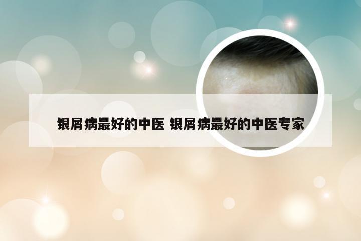 银屑病最好的中医 银屑病最好的中医专家