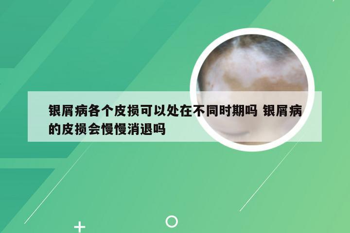 银屑病各个皮损可以处在不同时期吗 银屑病的皮损会慢慢消退吗