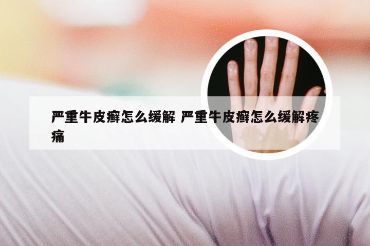 严重牛皮癣怎么缓解 严重牛皮癣怎么缓解疼痛