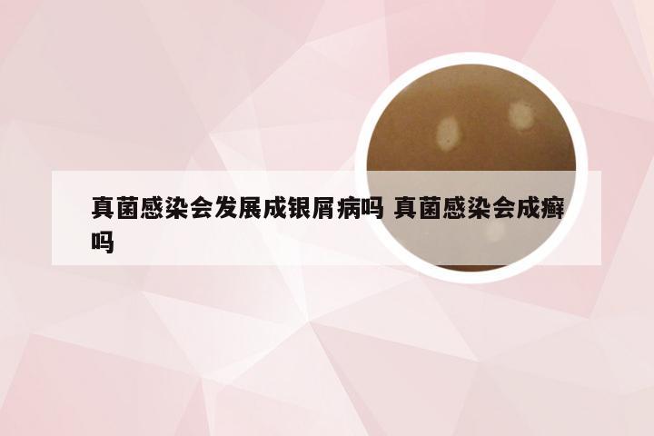 真菌感染会发展成银屑病吗 真菌感染会成癣吗