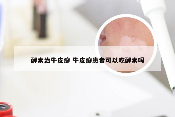 酵素治牛皮癣 牛皮癣患者可以吃酵素吗