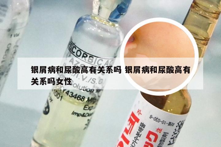 银屑病和尿酸高有关系吗 银屑病和尿酸高有关系吗女性