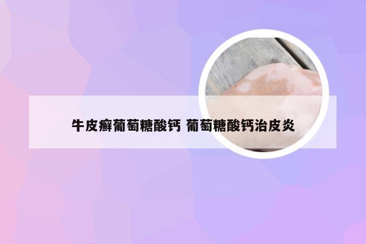 牛皮癣葡萄糖酸钙 葡萄糖酸钙治皮炎